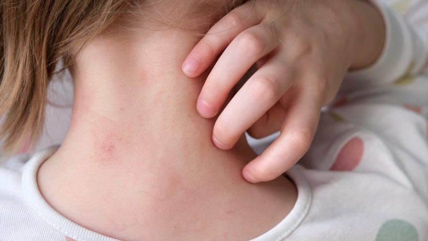 La vuelta al cole y la dermatitis atópica