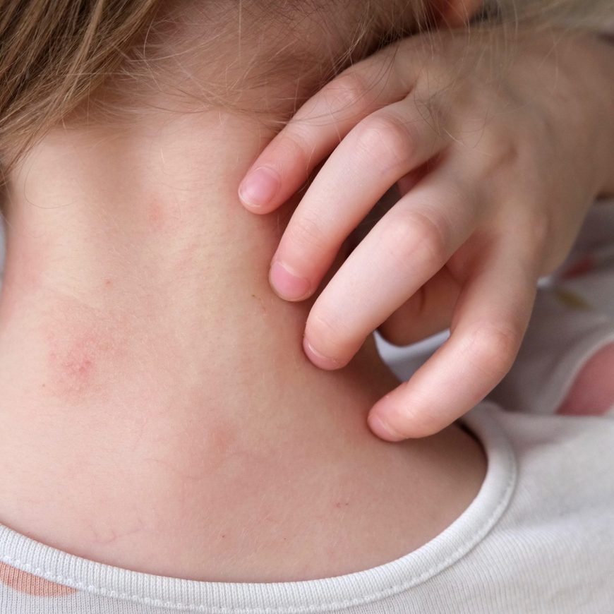 La vuelta al cole y la dermatitis atópica